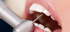 zobni implantati - ustna medicina