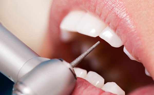 zobni implantati - ustna medicina