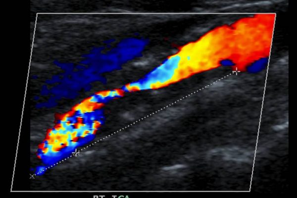 ultrazvok vratnih žil cena