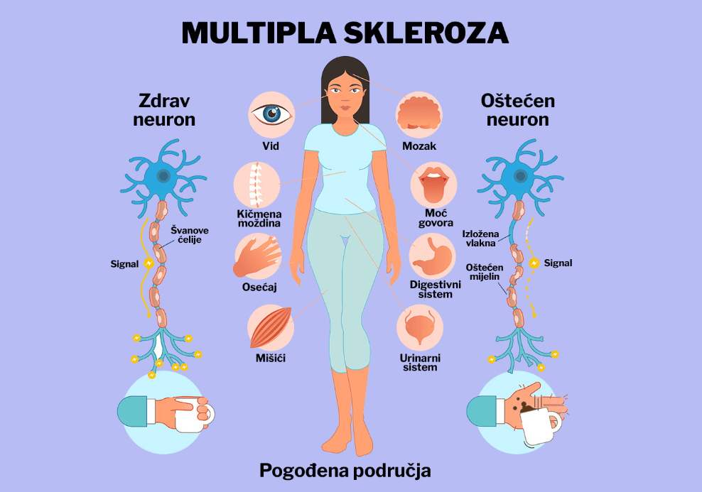 multiplaskleroza (1)